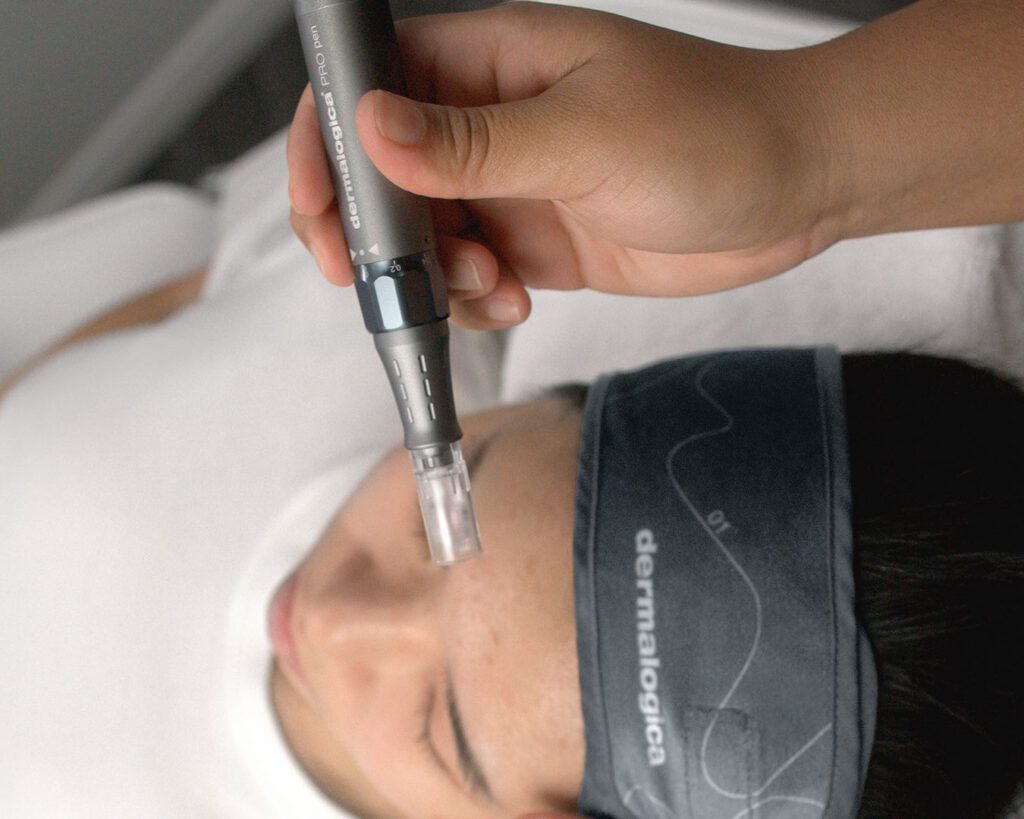Microneedling Gesichtsbehandlung mit Dermalogica-Produkten in Erding